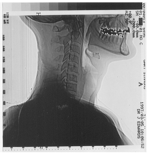 Gary's CT Scan showing foreign objects