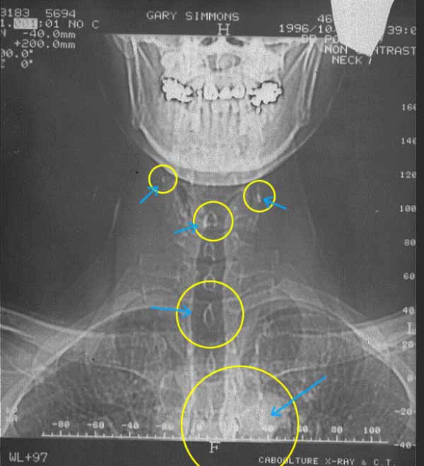 X - Ray { A } NEG