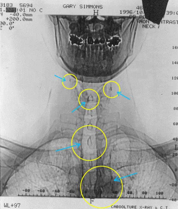 X - Ray { A } POSITIVE