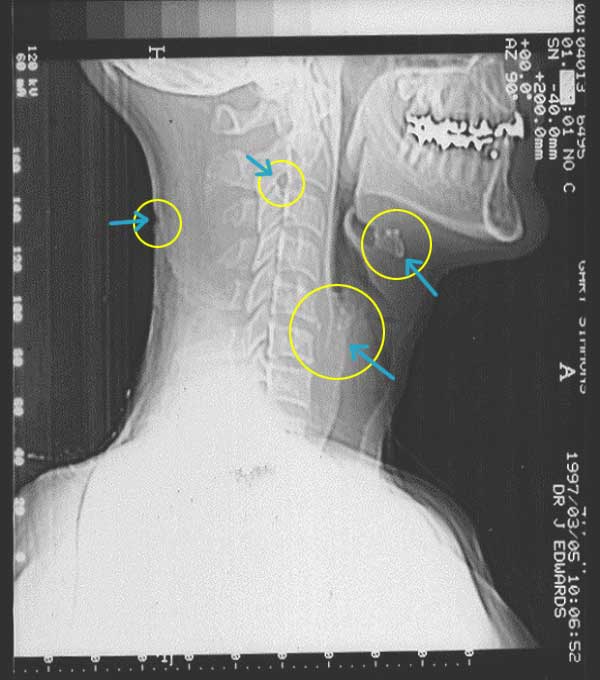 X - Ray { B } NEG