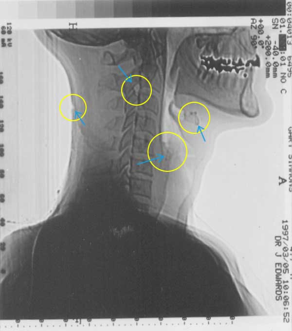 X - Ray { B } POSITIVE